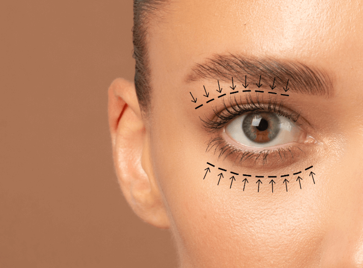 blepharoplasty surgeon