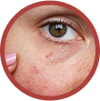 broken capillaries