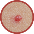 cherry angioma