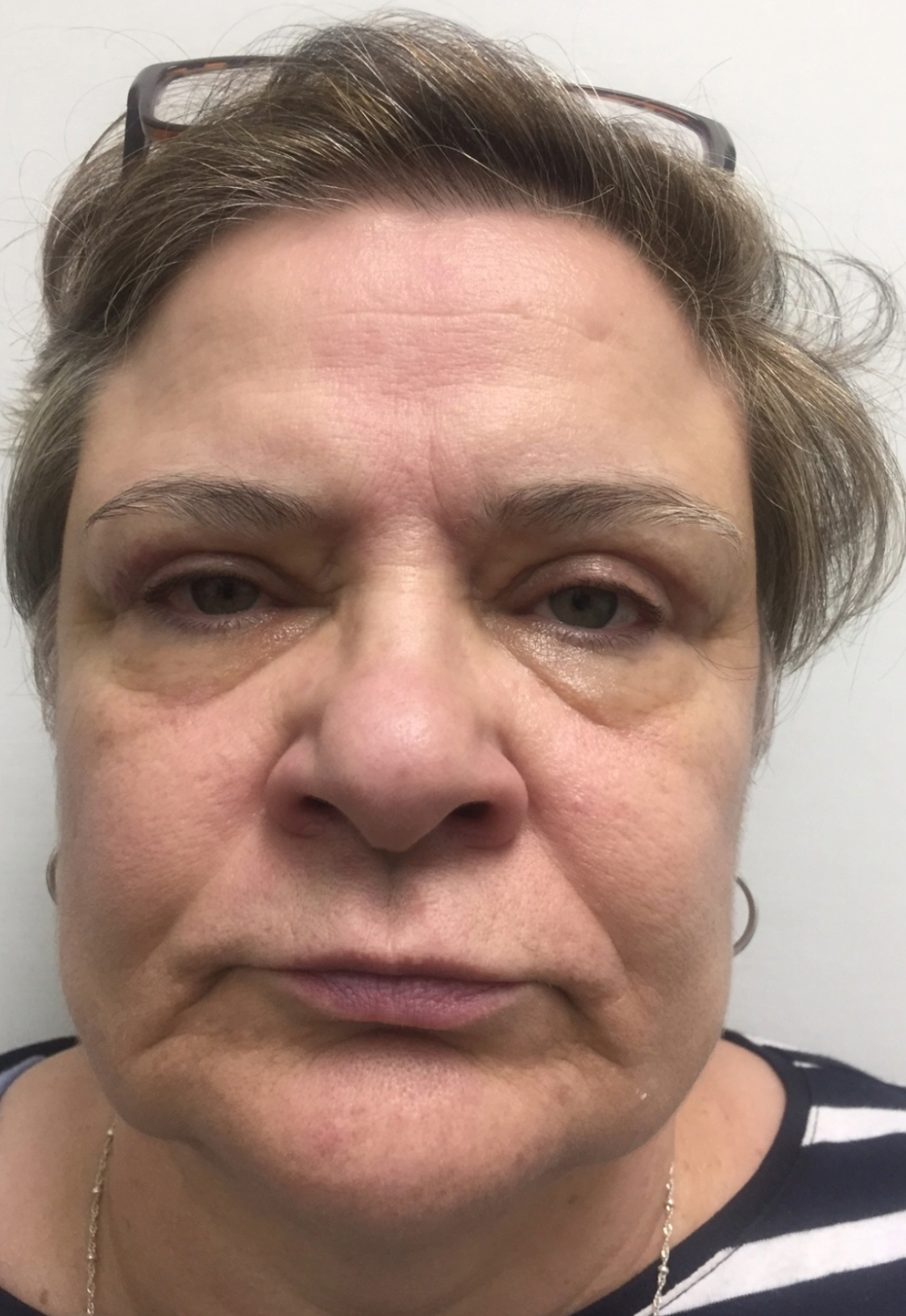 eyelid surgery before and after a 2