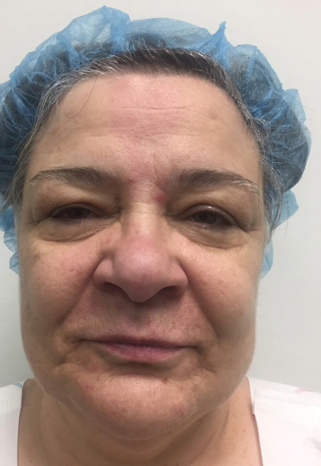 eyelid surgery before and after b 1