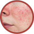 facial flushing