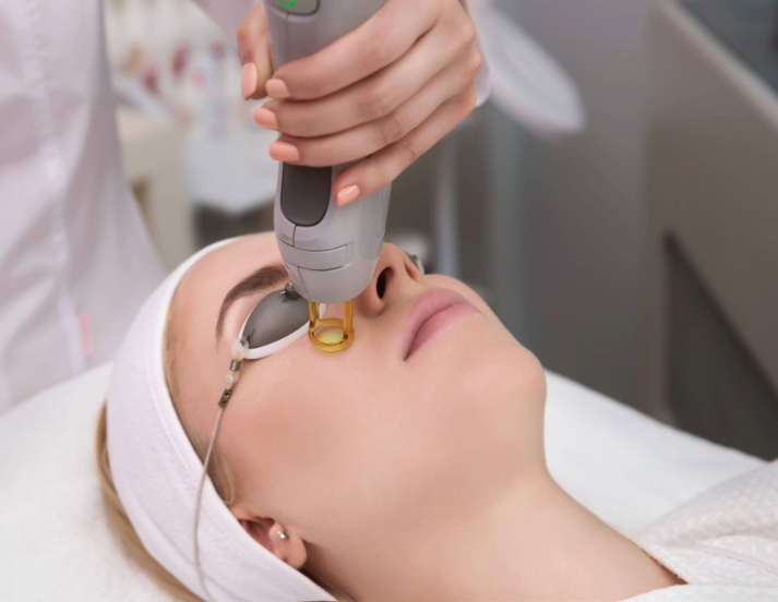 Laser treatment for spider veins on face