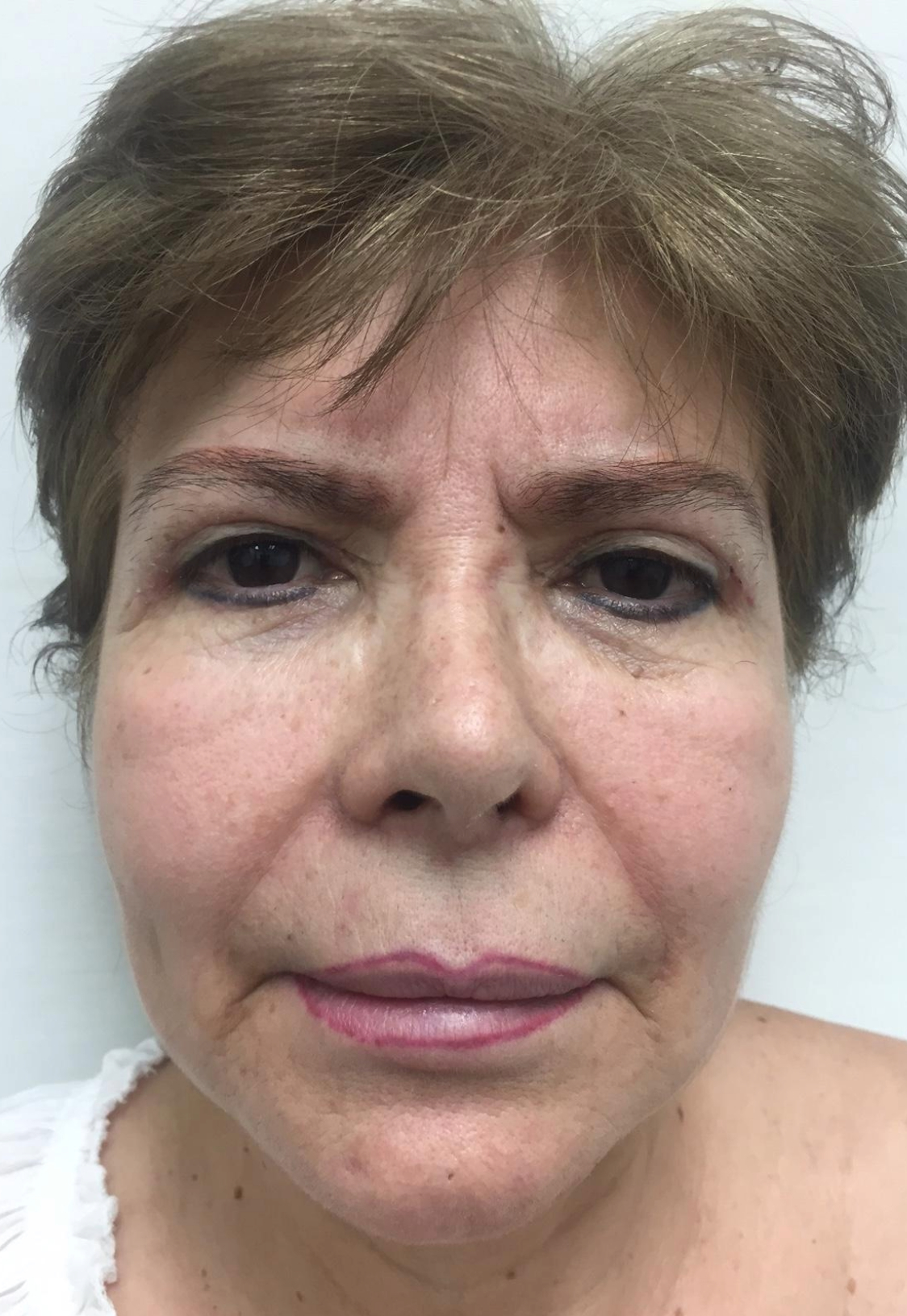 lower blepharoplasty before and after a 1