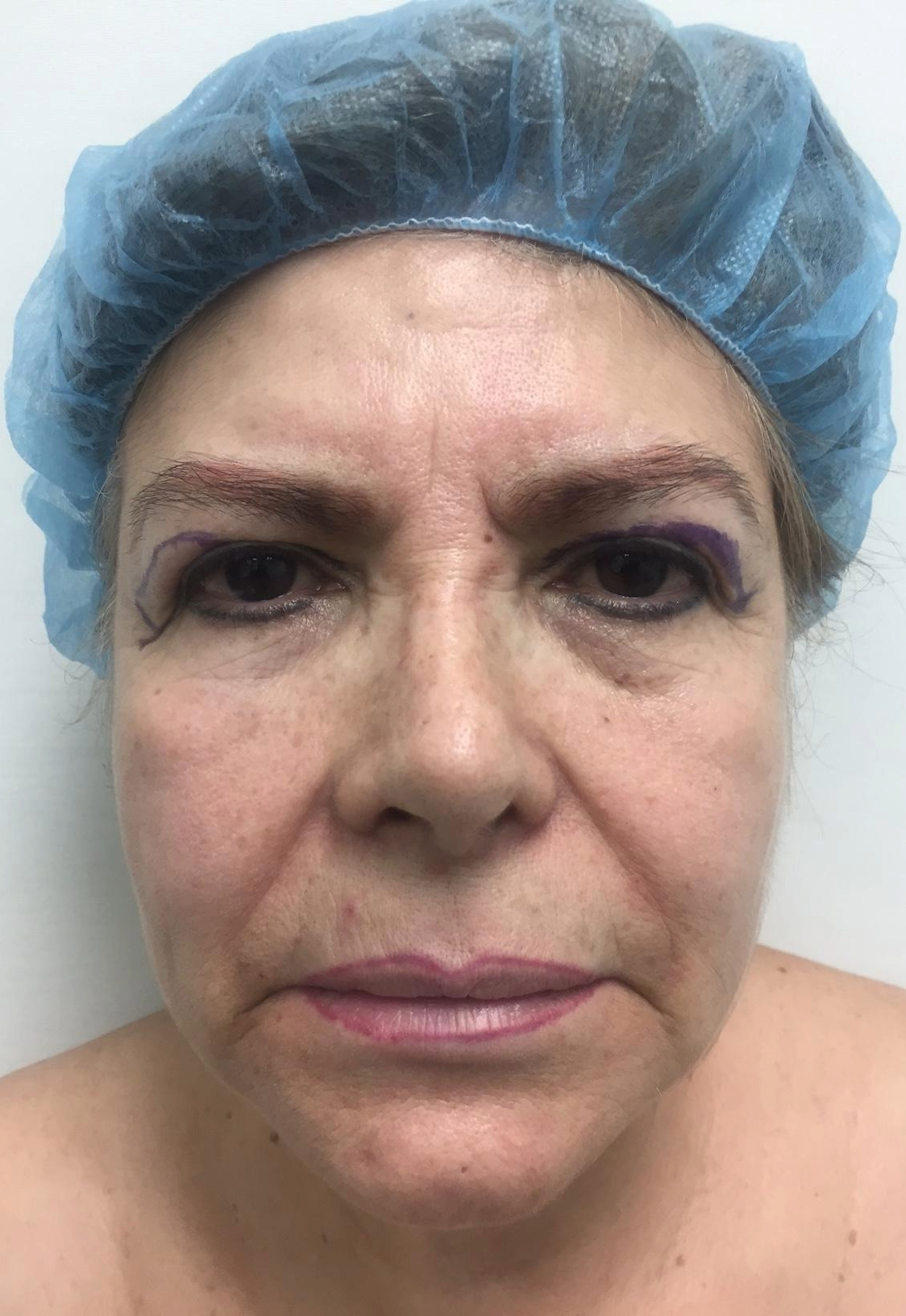 lower blepharoplasty before and after b 2