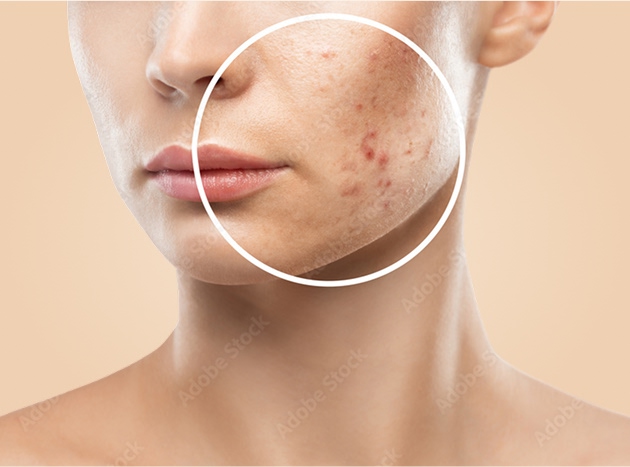 PRP scar treatment