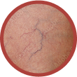 spider veins telangiectasia