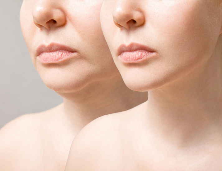 submental liposuction cost