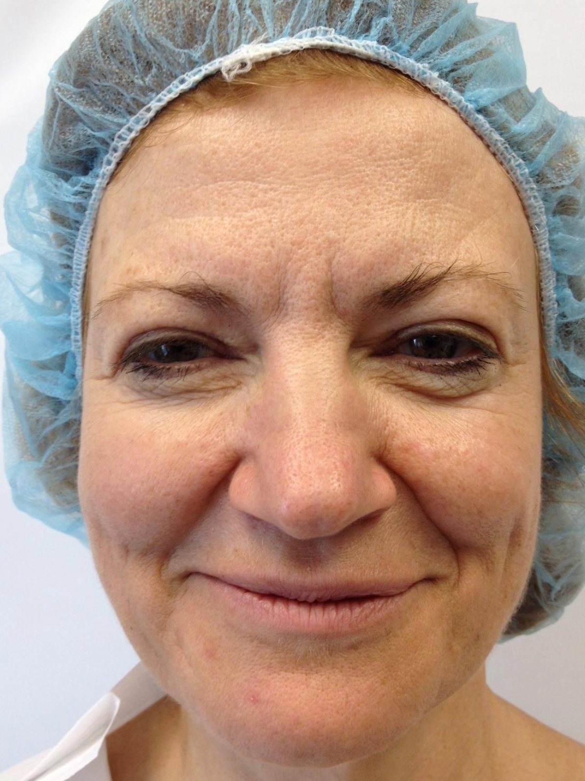 upper blepharoplasty before and after a 2