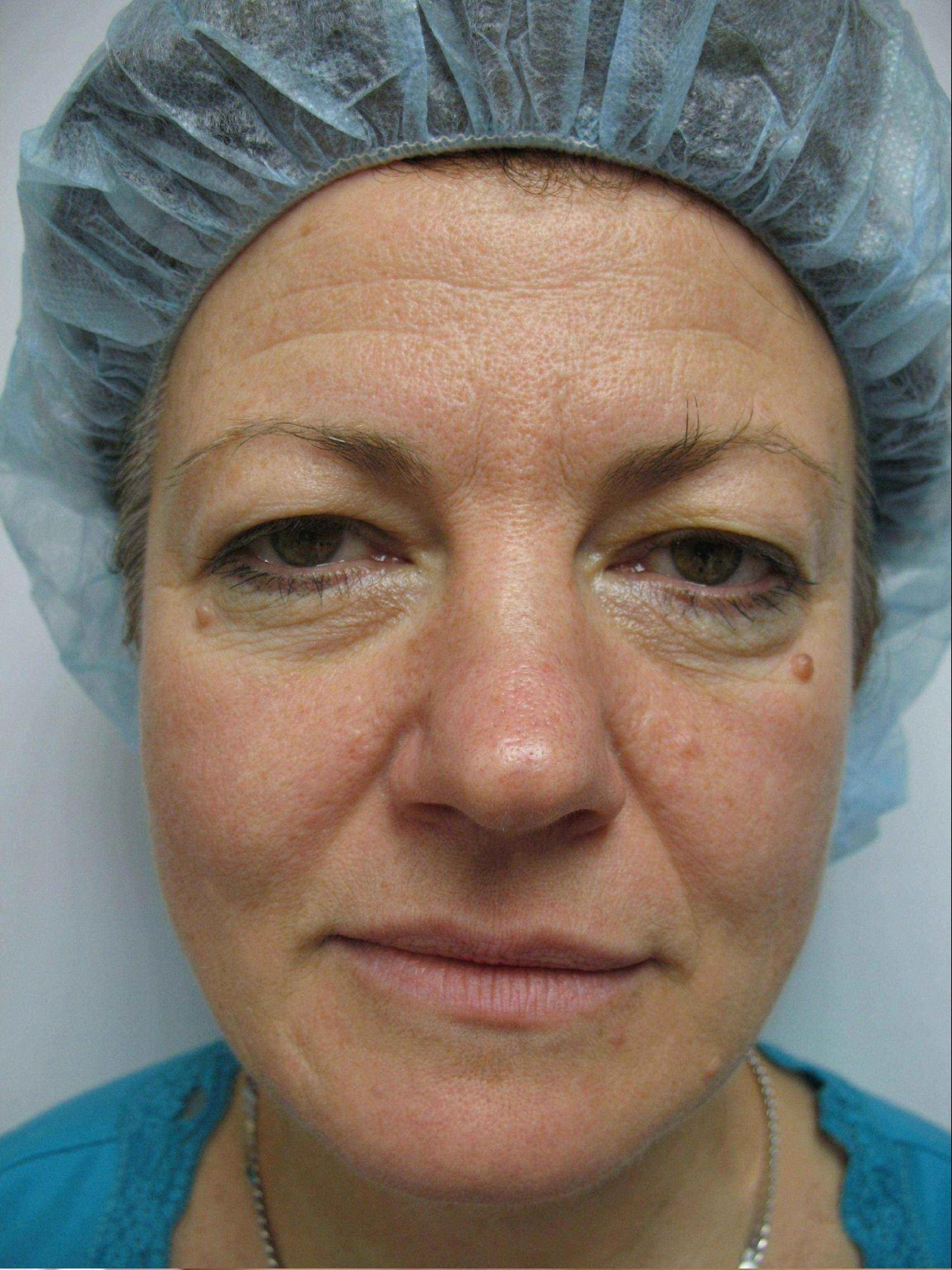 upper blepharoplasty before and after b 2