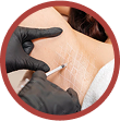 axillary hyperhidrosis