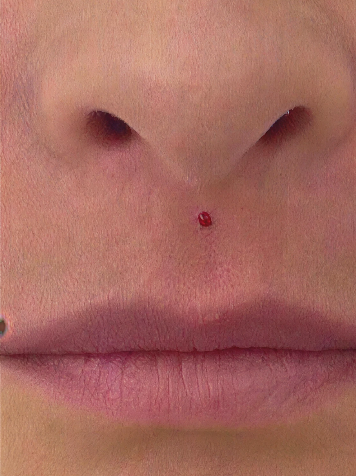 dermal fillers àfter 3