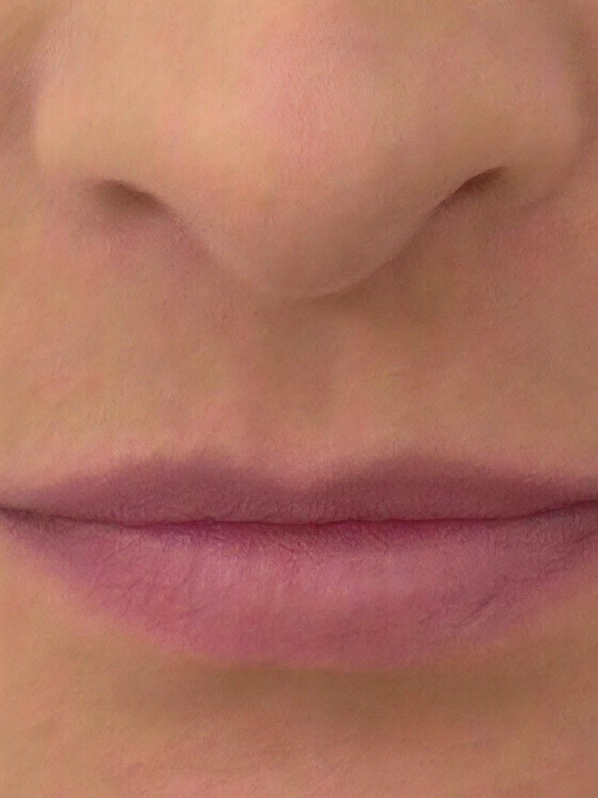 dermal fillers before 3