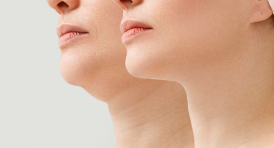 Double Chin Liposuction