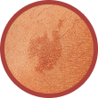 Flat Pigmented Birthmarks