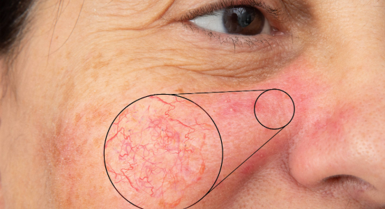 Laser Facial Vessels Treatment