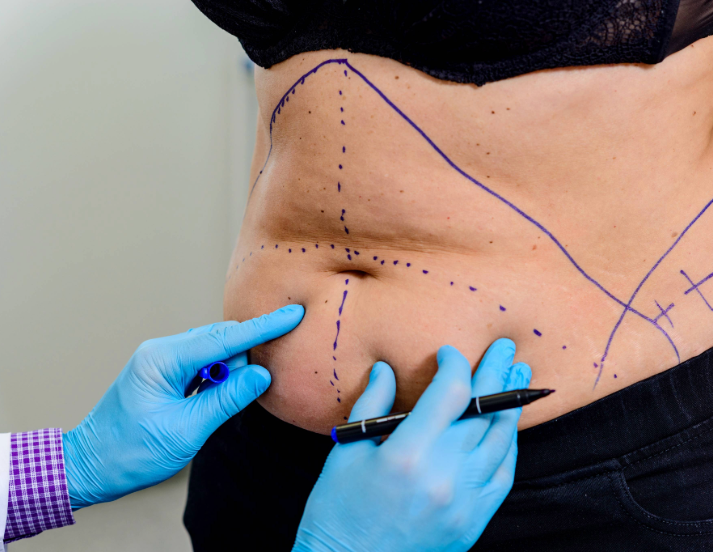laser liposuction cost