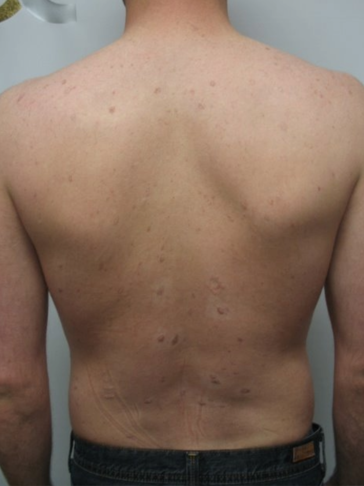 Laser Pigment Removal After 1