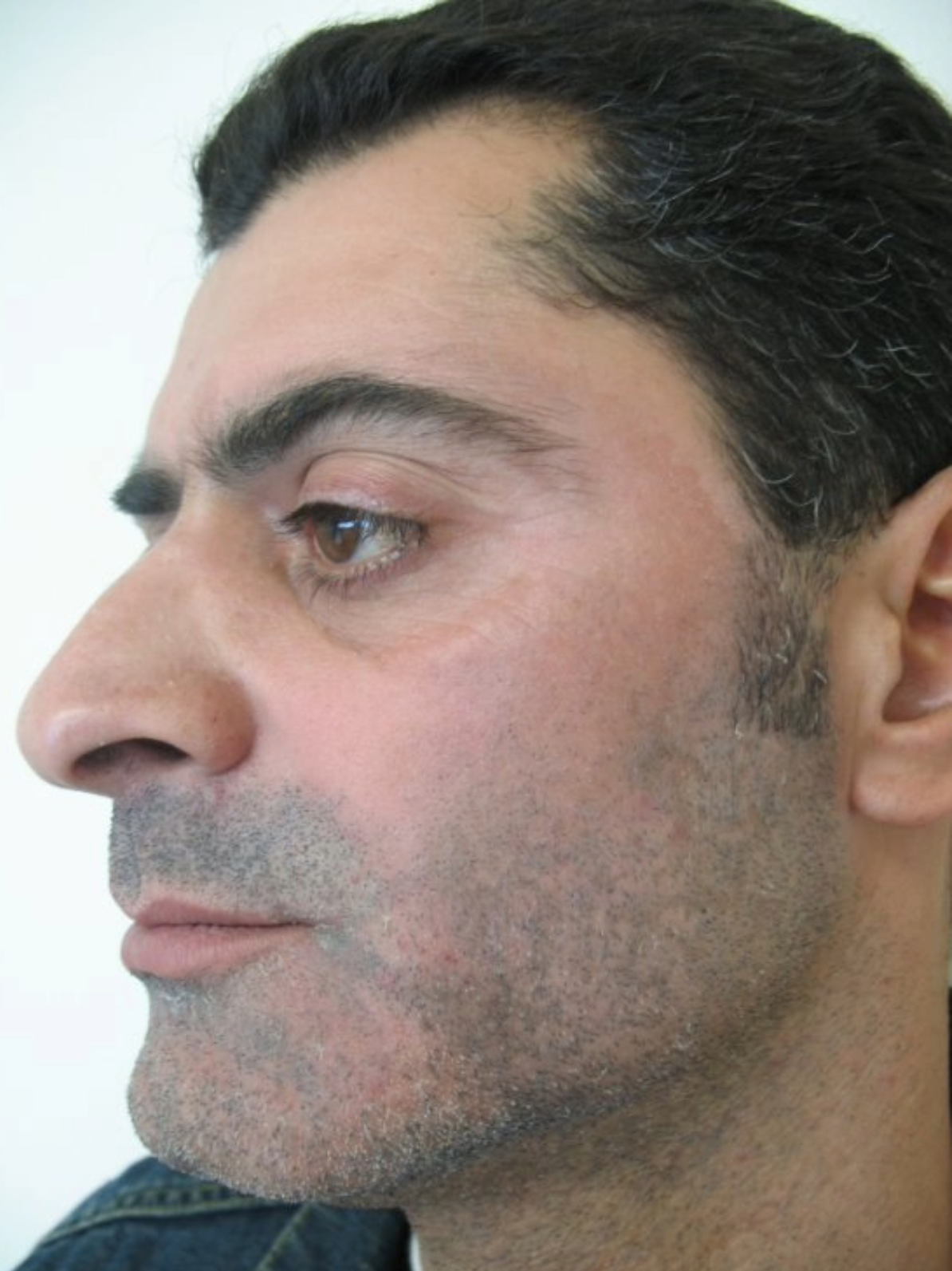 Laser Pigment Removal After 2
