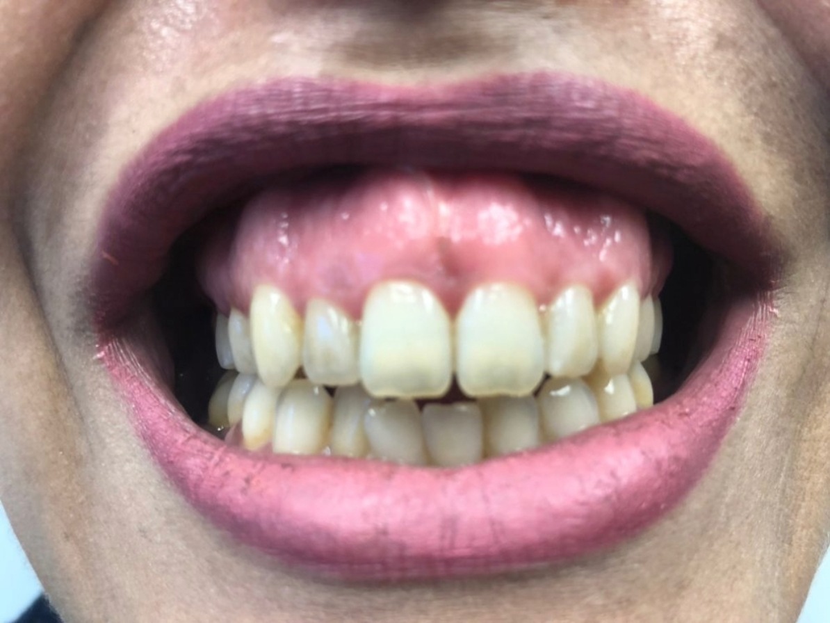 Laser Pigment Removal After 3