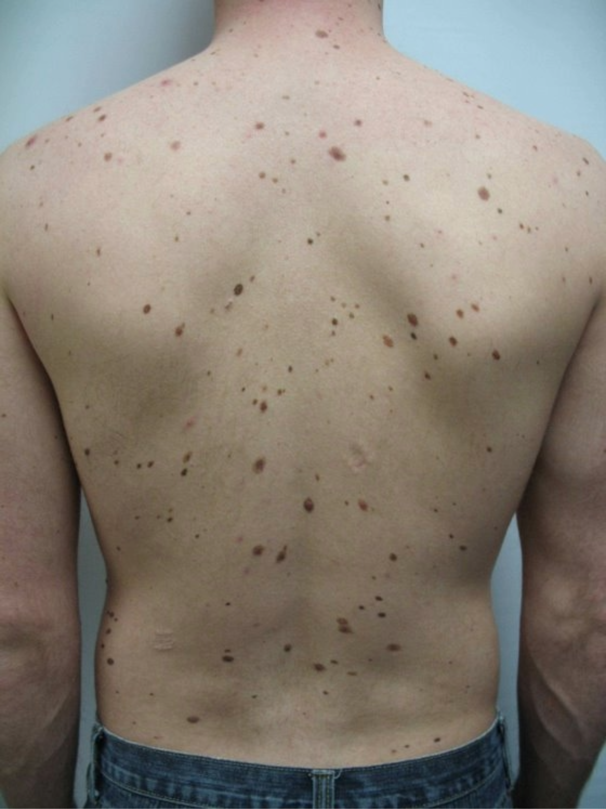 Laser Pigment Removal Before 1