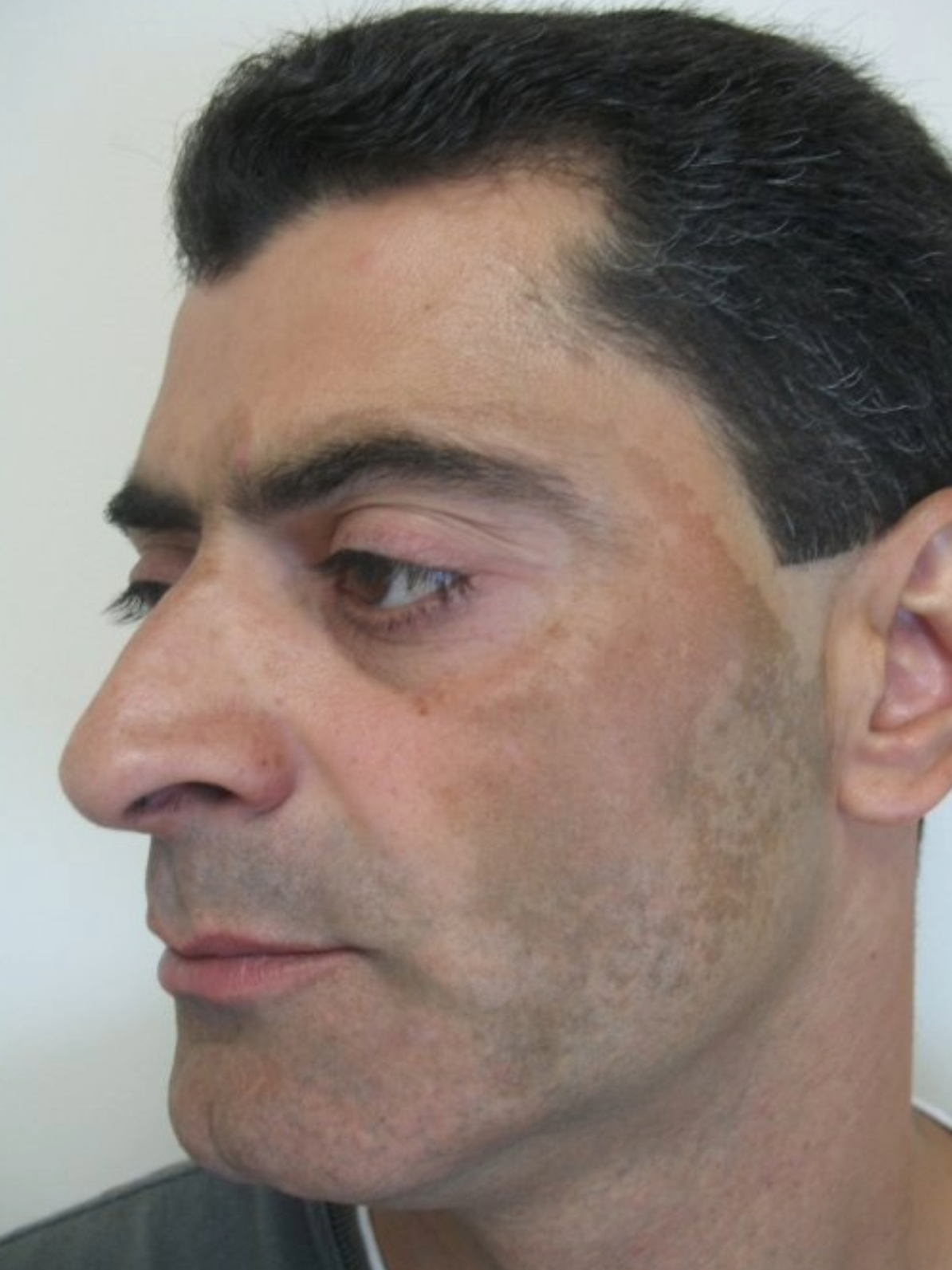 Laser Pigment Removal Before 2