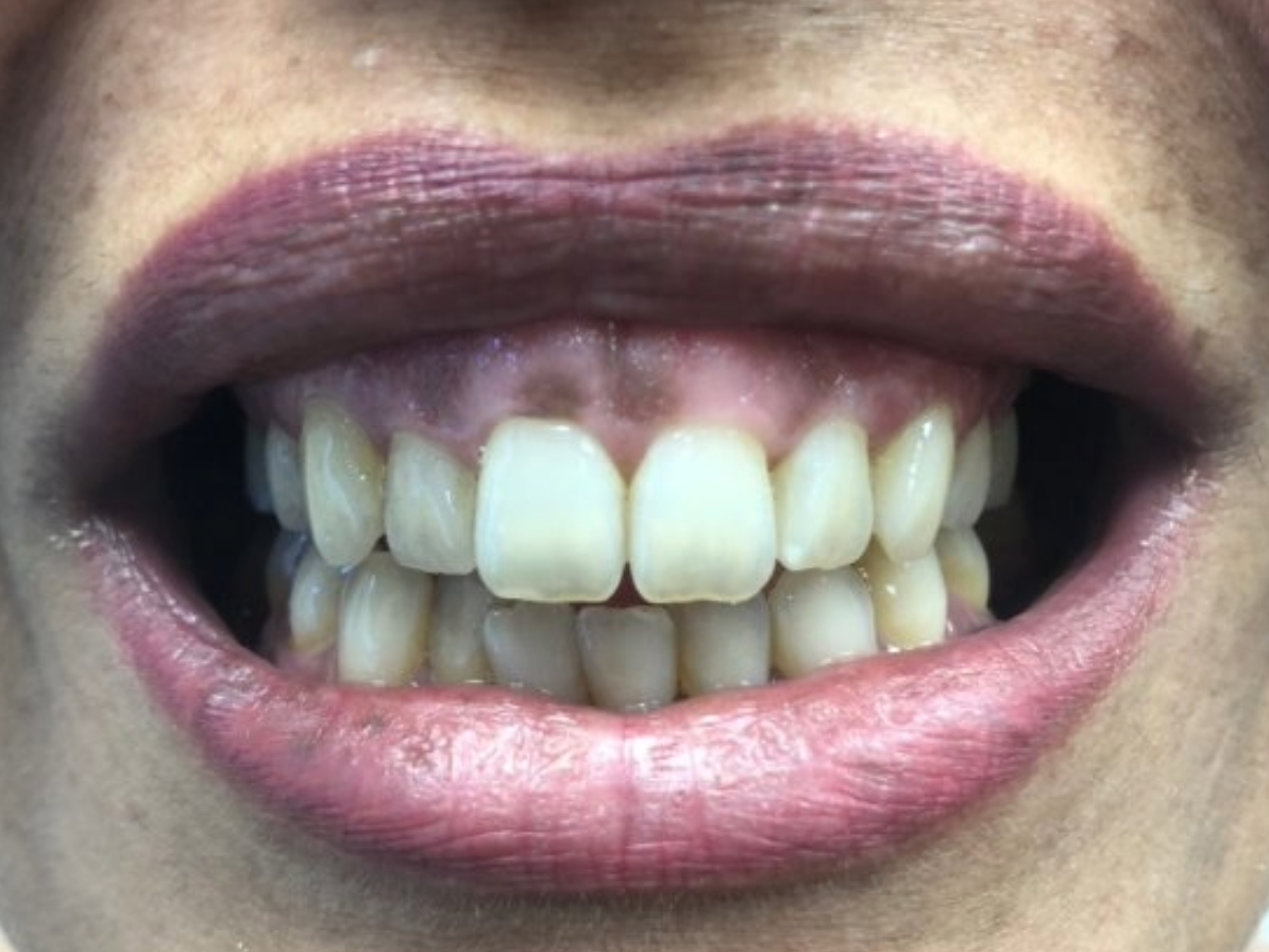 Laser Pigment Removal Before 3