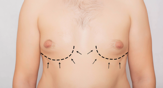 Male Breast Reduction (Gynecomastia)