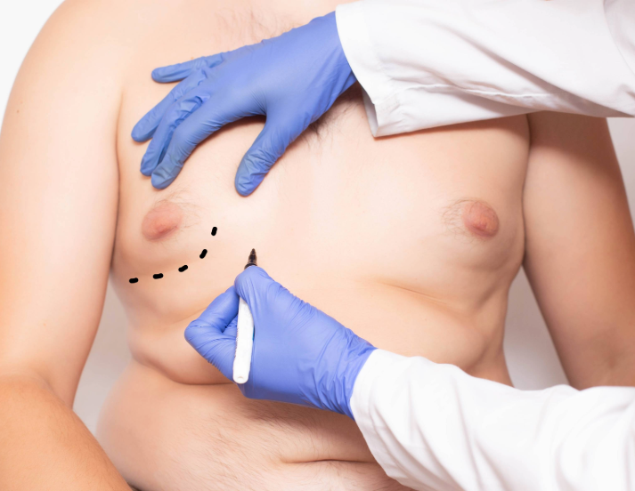 male breast reduction procedure