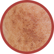 Melasma