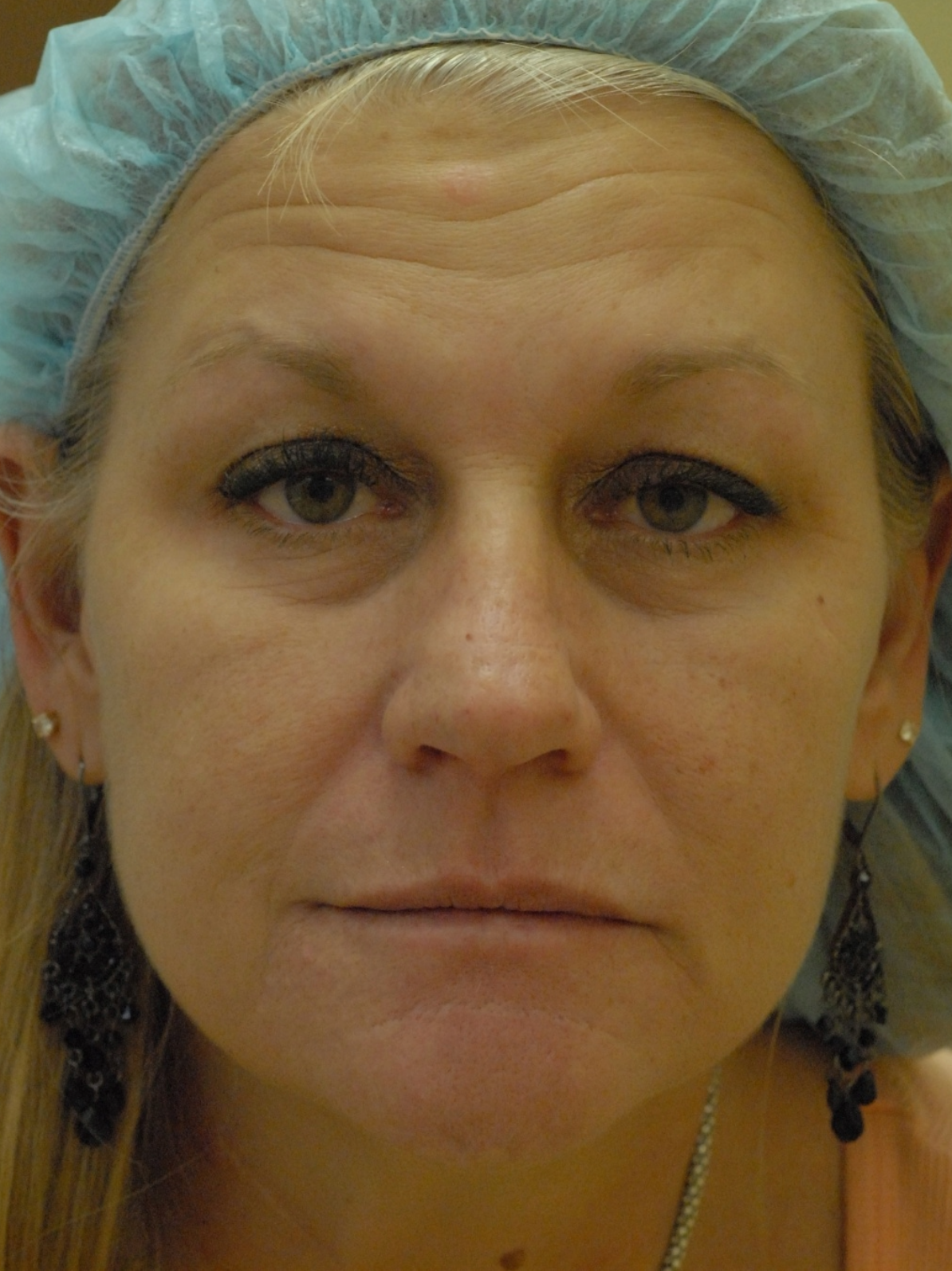 Mini Facelift Before 2
