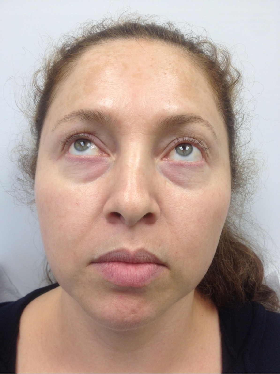 Mini Facelift Before 3