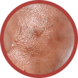 Post Inflammatory Hyperpigmentation