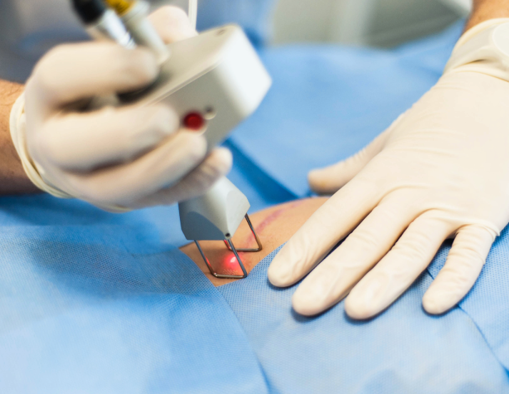scar revision procedure