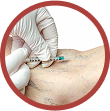 Sclerotherapy Injections
