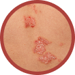 Skin Lesion Removal