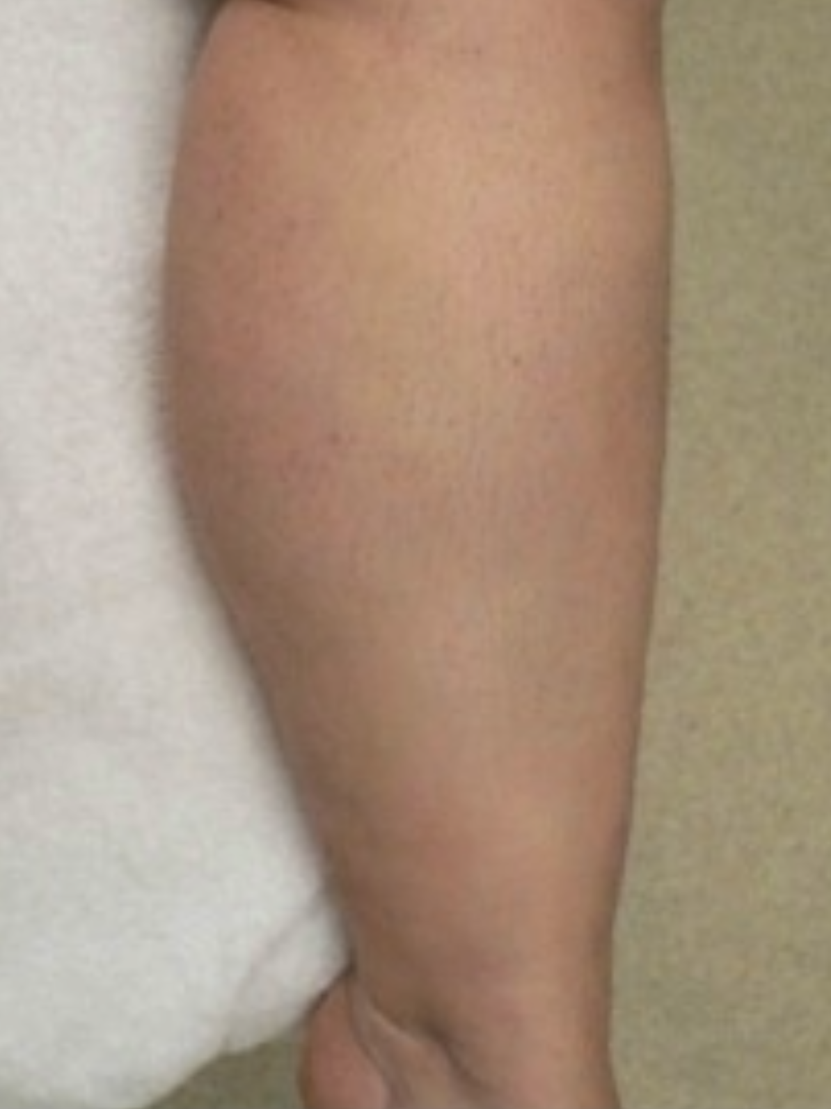 Spider Vein Removal after 2