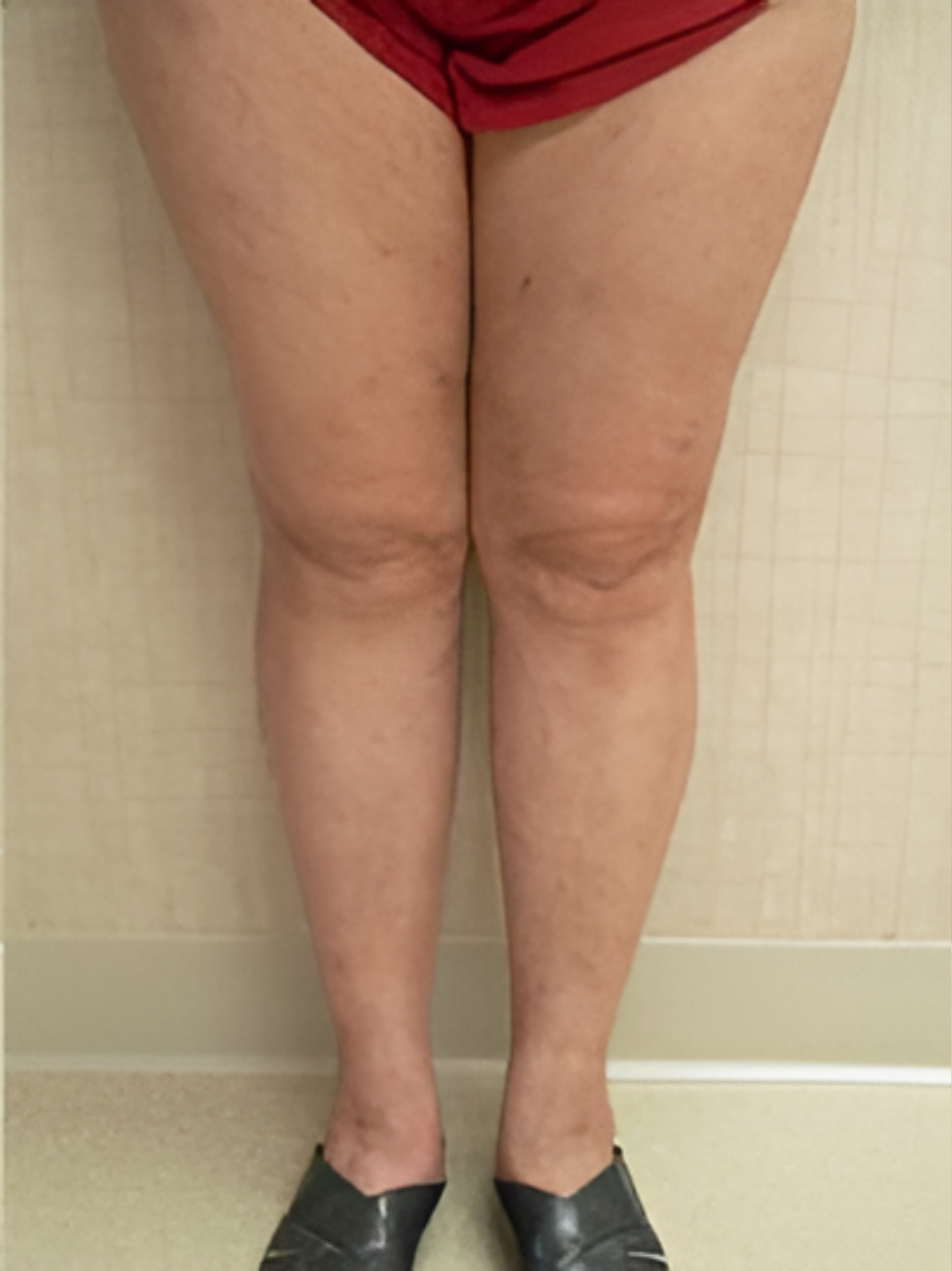 Spider Vein Removal after3