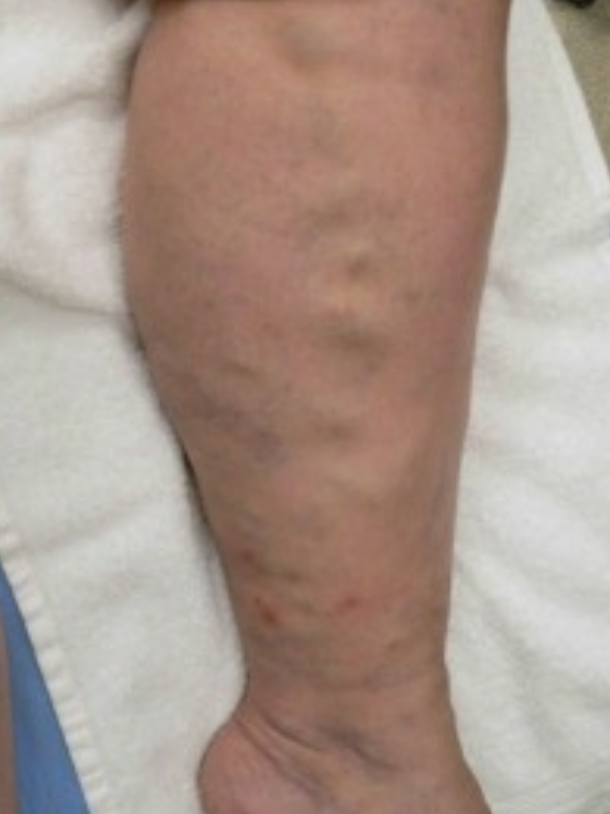Spider Vein Removal before 2