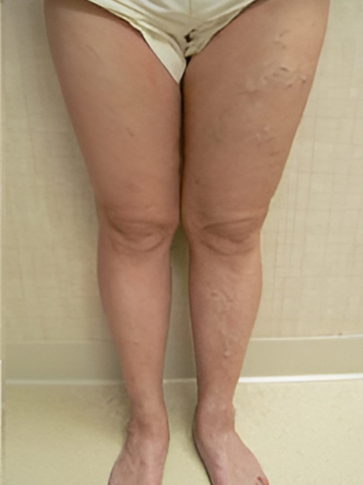 Spider Vein Removal before3