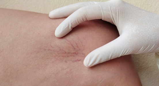 Spider Vein Removal