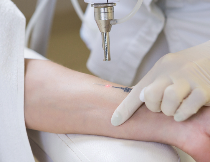 tattoo laser removal New Jersey