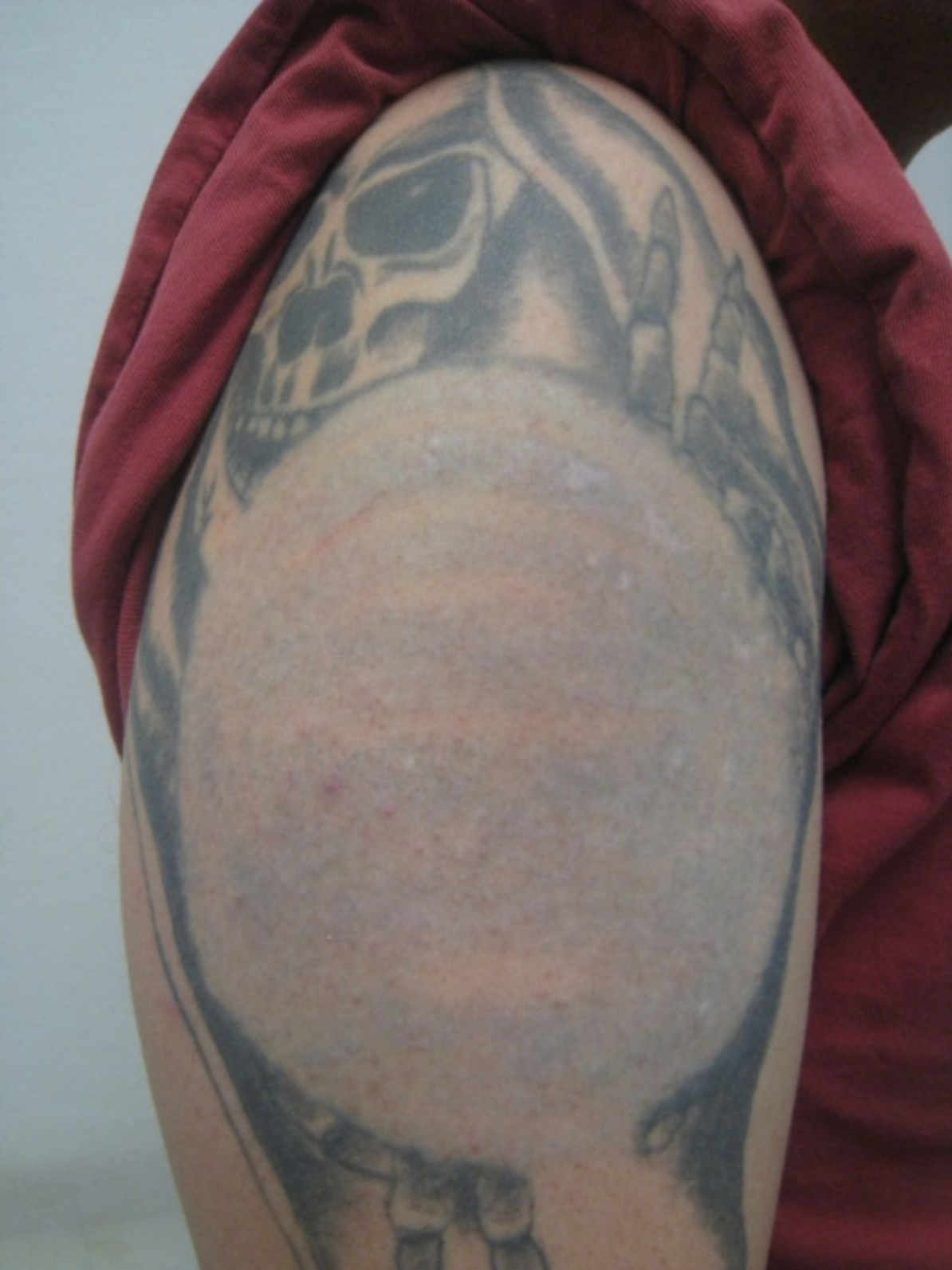 tattoo removal after 2