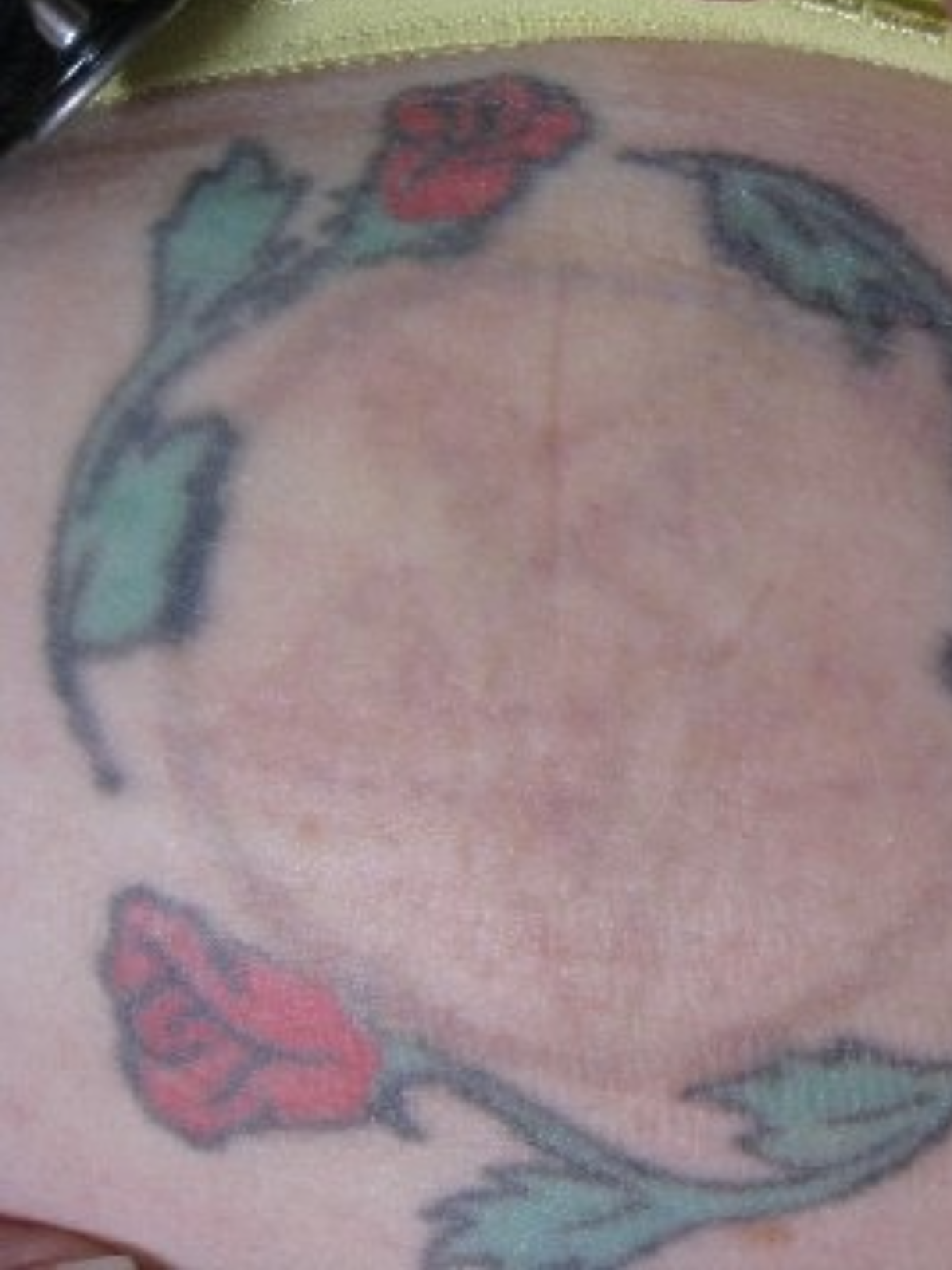tattoo removal after 3