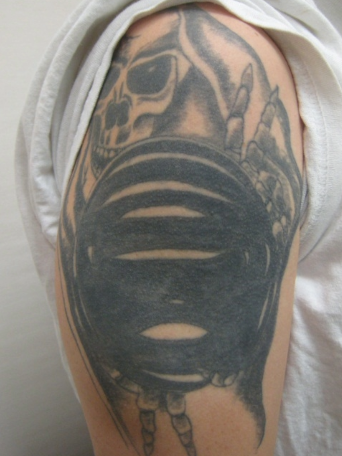 tattoo removal before 2