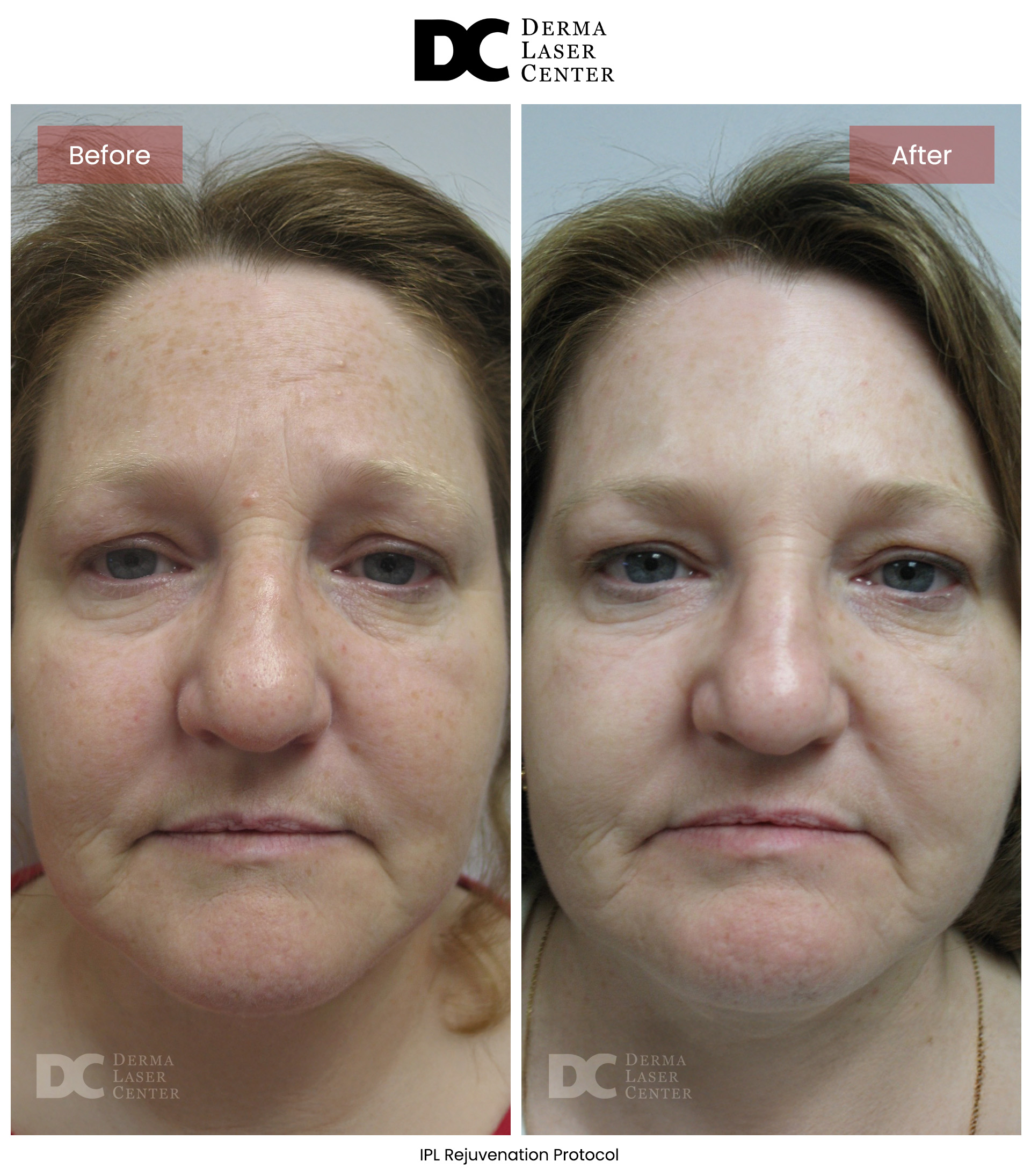 B&A Acne Image 01 V2