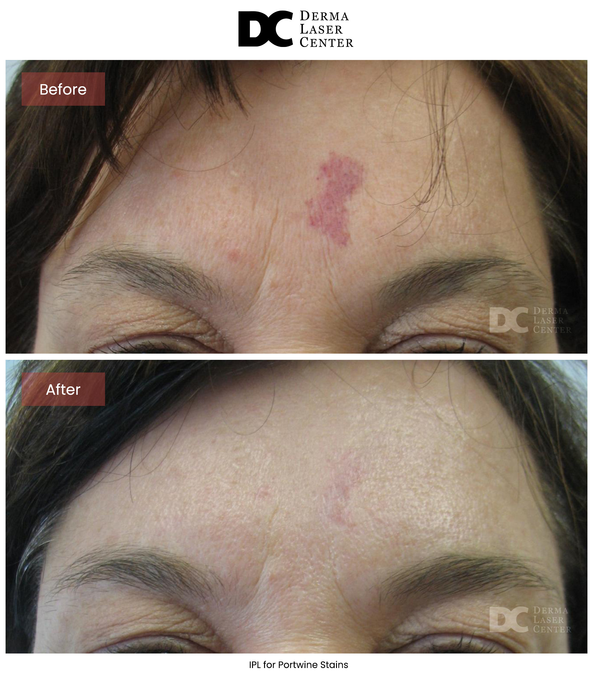 B&A Acne Image 02 V2