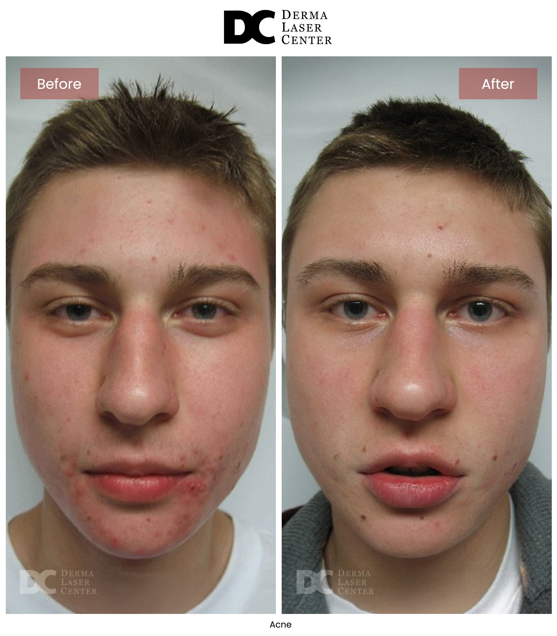 B&A Acne Image 03 V2