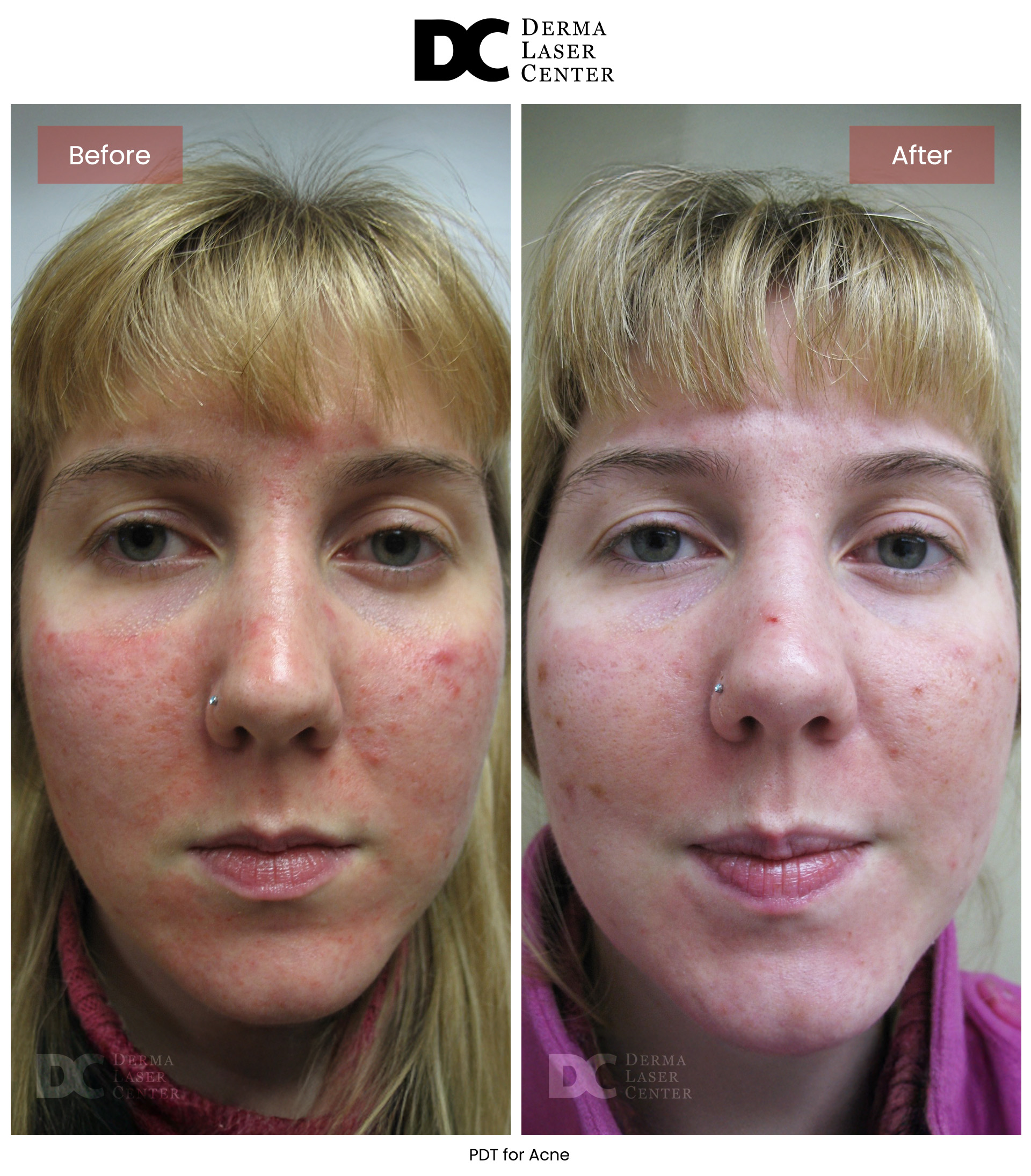 B&A Acne Image 04 V2