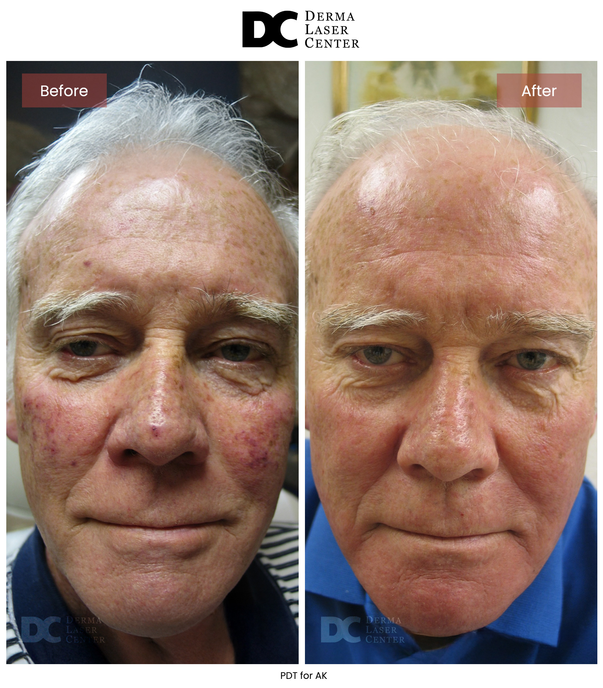 B&A Acne Image 06 V2